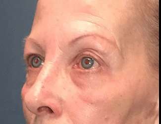 Blepharoplasty Before & After Patient #2271