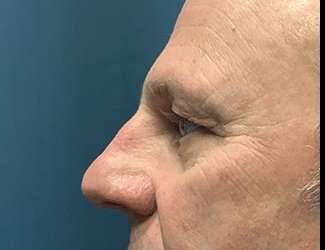 Blepharoplasty Before & After Patient #2282