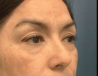 Blepharoplasty Before & After Patient #2293