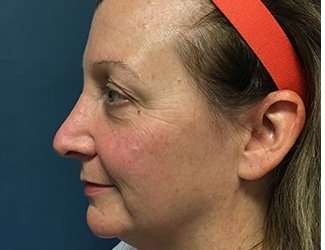 Blepharoplasty Before & After Patient #2308