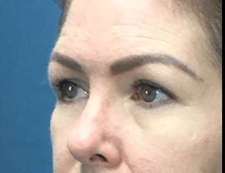 Blepharoplasty Before & After Patient #2315
