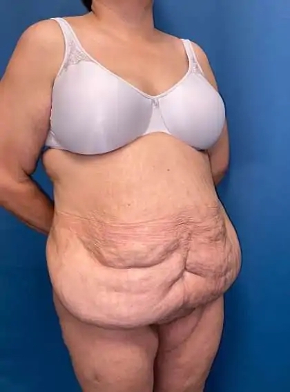 Tummy Tuck Before & After Patient #446