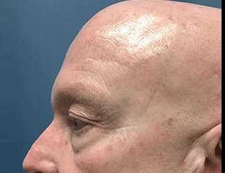 Blepharoplasty Before & After Patient #2328