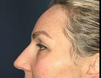 Blepharoplasty Before & After Patient #2339