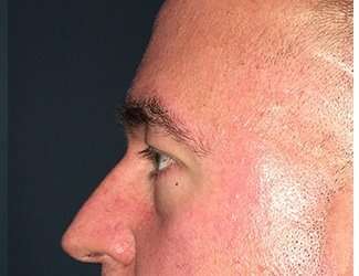 Blepharoplasty Before & After Patient #2352