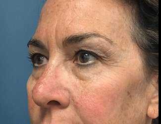 Blepharoplasty Before & After Patient #2368