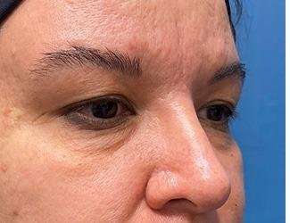 Blepharoplasty Before & After Patient #2385