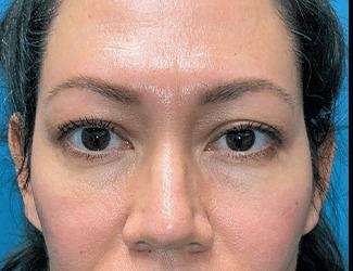 Blepharoplasty Before & After Patient #2390