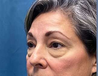 Blepharoplasty Before & After Patient #2397