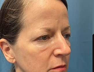 Blepharoplasty Before & After Patient #2408