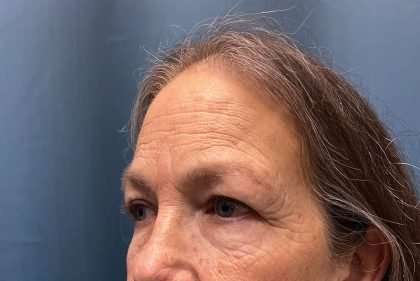 Blepharoplasty Before & After Patient #2419