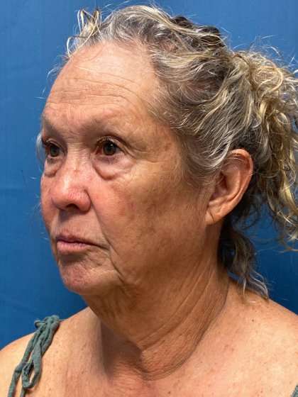 Blepharoplasty Before & After Patient #2430