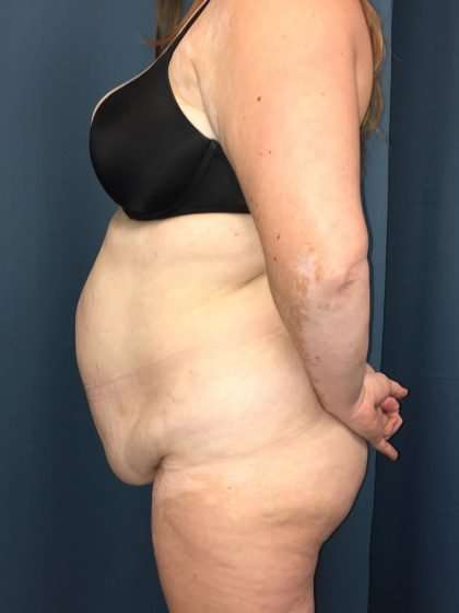 Tummy Tuck Before & After Patient #271