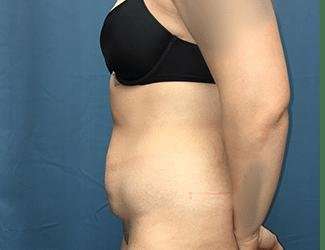 Tummy Tuck Before & After Patient #457