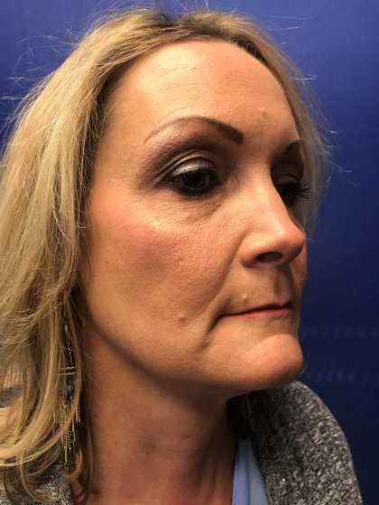Blepharoplasty Before & After Patient #2437
