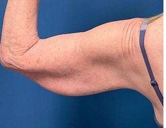 Arm Lift Before & After Patient #2473