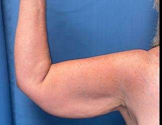 Arm Lift Before & After Patient #2482