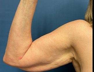 Arm Lift Before & After Patient #2491