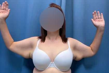 Arm Lift Before & After Patient #2498