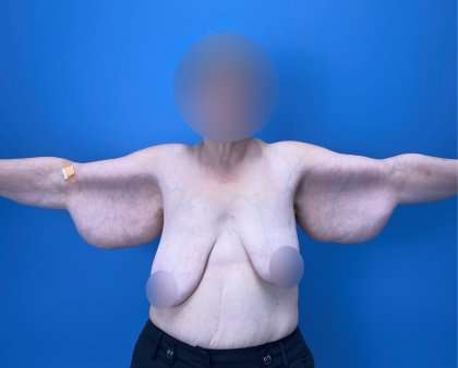 Arm Lift Before & After Patient #2503