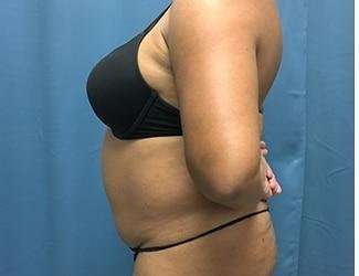 Tummy Tuck Before & After Patient #468