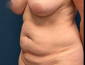 Tummy Tuck Before & After Patient #475