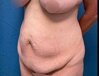Tummy Tuck Before & After Patient #482