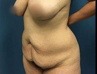 Tummy Tuck Before & After Patient #493