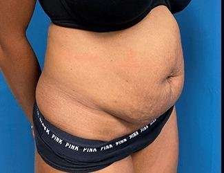 Tummy Tuck Before & After Patient #504