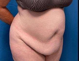 Tummy Tuck Before & After Patient #515