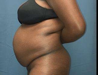 Tummy Tuck Before & After Patient #528