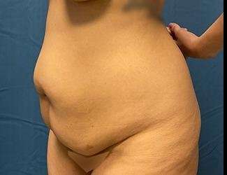 Tummy Tuck Before & After Patient #535