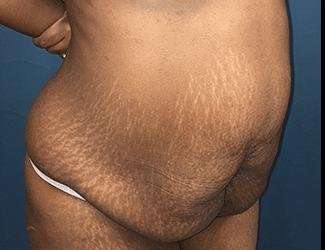 Tummy Tuck Before & After Patient #546