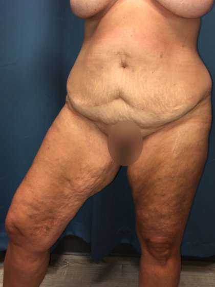 Thigh Lift Before & After Patient #553