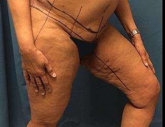 Thigh Lift Before & After Patient #558
