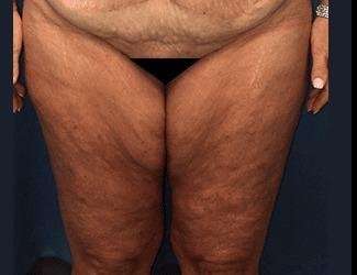 Thigh Lift Before & After Patient #563