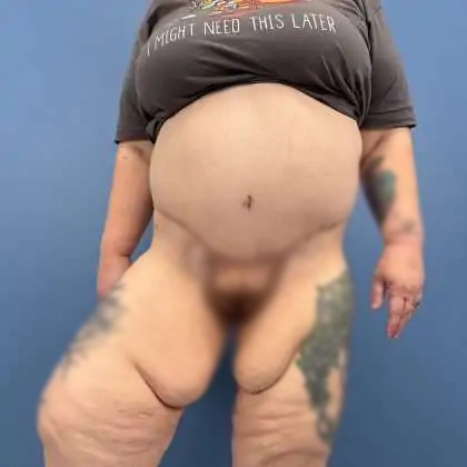 Thigh Lift Before & After Patient #579