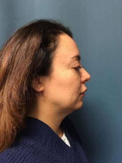 Submentoplasty Before & After Patient #586