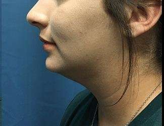 Submentoplasty Before & After Patient #610