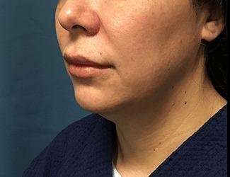 Submentoplasty Before & After Patient #621