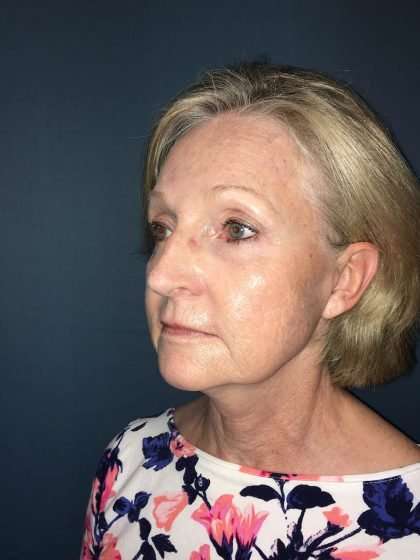 Submentoplasty Before & After Patient #654