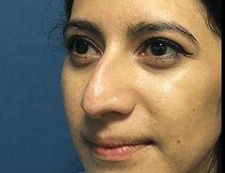 Rhinoplasty Before & After Patient #667