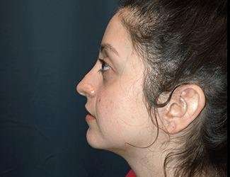 Rhinoplasty Before & After Patient #680