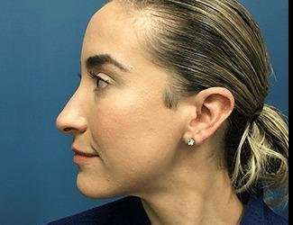 Rhinoplasty Before & After Patient #706