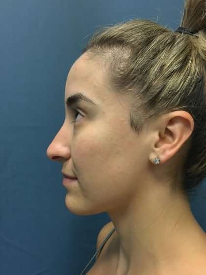 Rhinoplasty Before & After Patient #715