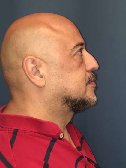Rhinoplasty Before & After Patient #722