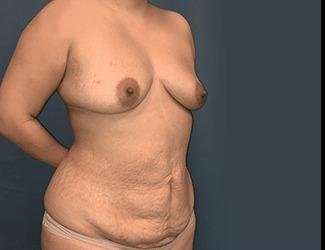 Mommy Makeover Before & After Patient #743