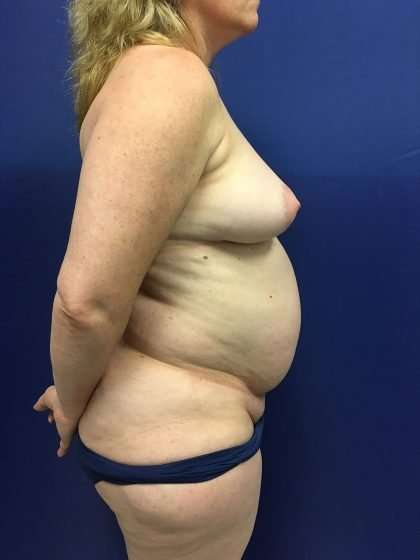 Mommy Makeover Before & After Patient #882