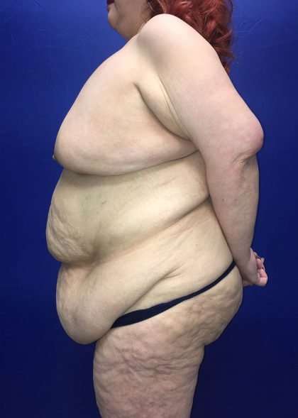 Mommy Makeover Before & After Patient #893