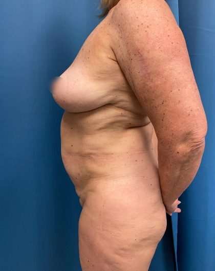 Tummy Tuck Before & After Patient #311